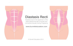 diastasis recti 